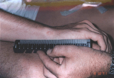 Figure 15. Injury sustained by British soldier during Fox testing.