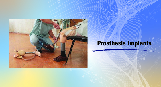 Prosthesis Implants 