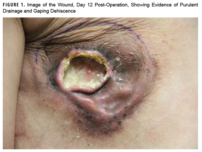 Image of the Wound, Day 12 Post-Operation, Showing Evidence of Purulent Drainage and Gaping Dehiscence. This photograph of the wound shows clear evidence of purulent drainage and gaping dehiscence. 