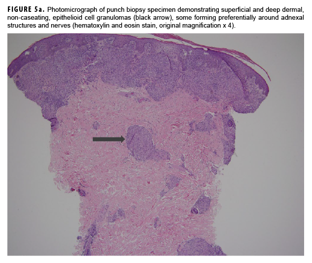 Photomicrograph of punch biopsy specimen demonstrating superficial and deep dermal, non-caseating, epithelioid cell granulomas (black arrow), some forming preferentially around adnexal structures and nerves (hematoxylin and eosin stain, original magnification x 4).