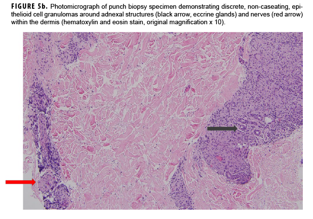 Photomicrograph of punch biopsy specimen demonstrating discrete, non-caseating, epithelioid cell granulomas around adnexal structures (black arrow, eccrine glands) and nerves (red arrow) within the dermis (hematoxylin and eosin stain, original magnification x 10).