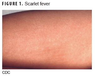 Scarlet fever