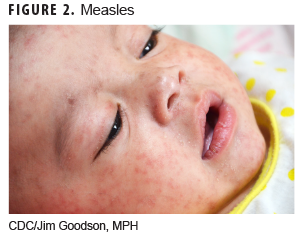 Measles