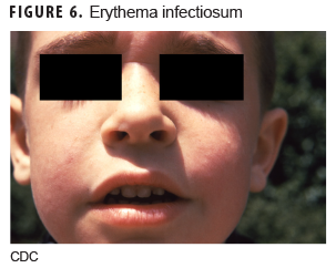 Erythema infectiosum