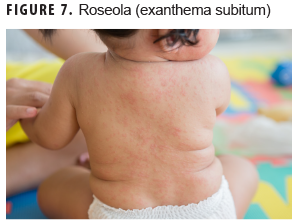 Roseola (exanthema subitum)