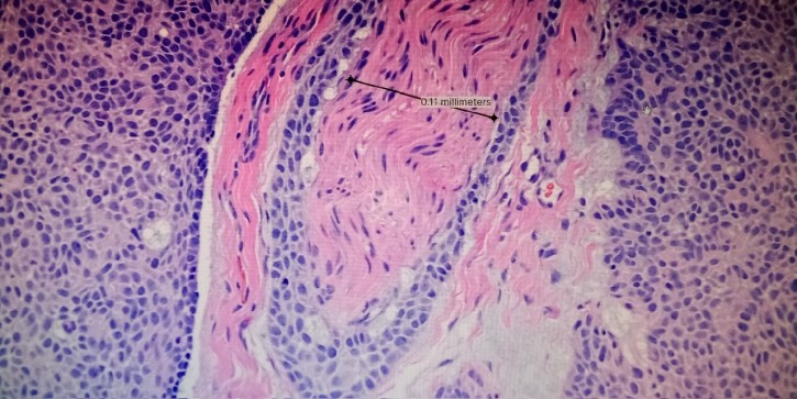 Dermatologists study pathology to diagnose and treat tumors. In this image, an aggressive basal cell carcinoma invades a nerve.