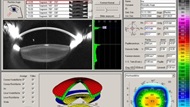 Corneal imaging taken as part of the preoperative workup.