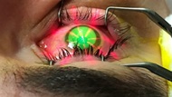 Intraoperative photo during refractive surgery.