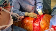 Fellow performing thoracotomy